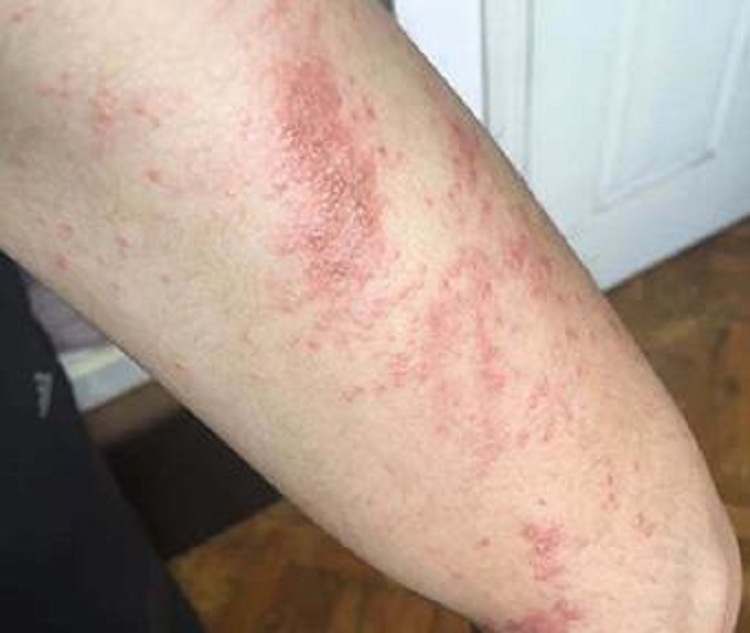 中山哪个皮肤病医院治疗 湿疹专业,中山肤斗士皮肤科